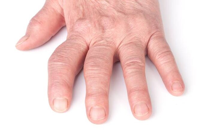 παραμορφωτική οστεοαρθρίτιδα στα χέρια