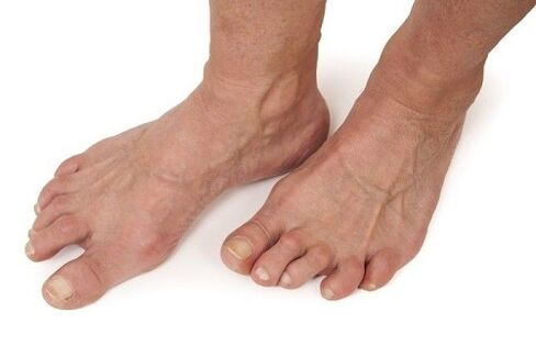 Πόδια που επηρεάζονται από οστεοαρθρίτιδα