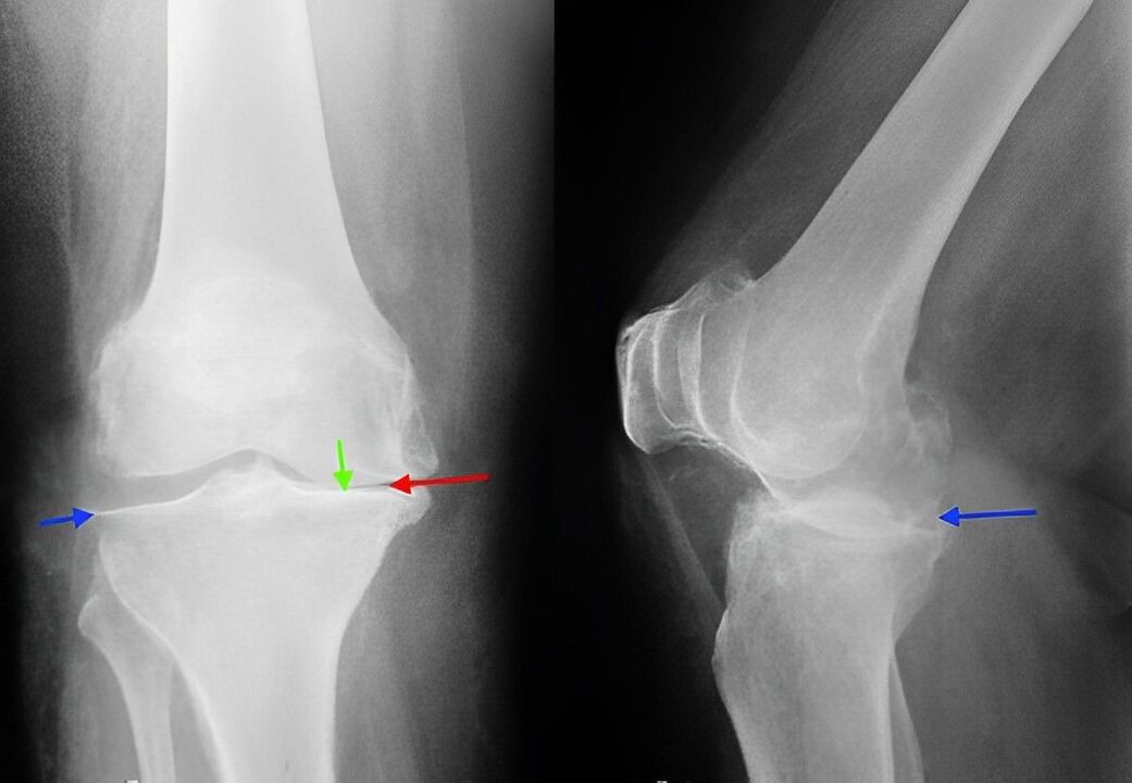 Ακτινογραφία οστεοαρθρίτιδας της άρθρωσης του γόνατος