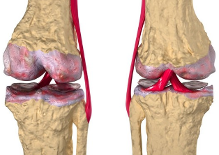 Οστεοαρθρίτιδα του γόνατος