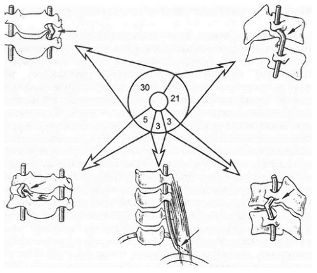 Ποιος είναι ο κίνδυνος οστεοχόνδρωσης του λαιμού;