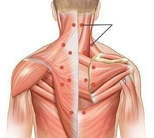 Η μυοσίτιδα ως αιτία του πόνου στην πλάτη