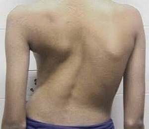Η σκολίωση ως αιτία του πόνου στην πλάτη