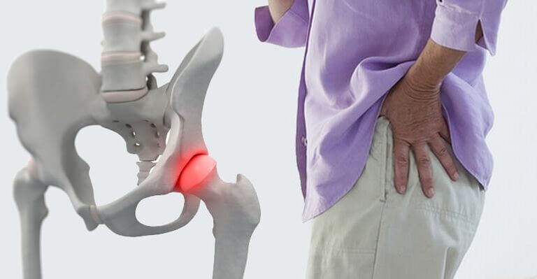 Πόνος στο ισχίο - ένα σύμπτωμα της οστεοαρθρίτιδας της άρθρωσης του ισχίου